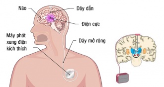 Chi phí phẫu thuật bệnh parkinson có đắt không? Lưu ý điều gì?